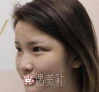 上海李元山隆鼻案例：鼻子挺立了网红感就来了~ width=