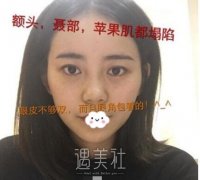 谈谈我在成都华人医联做双眼皮+脂肪填充的亲身经历 width=