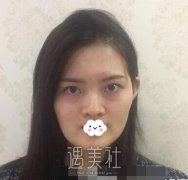 成都军大杨勇做的鼻子，大家说有变好看些吗？ width=