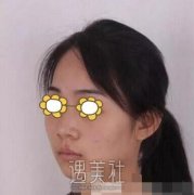 长沙南湖整形隆鼻案例：爱上了这个弧度 width=