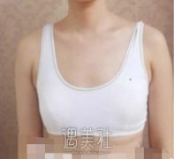 上海九院余力隆胸案例：没有什么“大”不了 width=