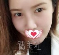 罗旭松双眼皮修复案例：这次做双眼皮终于选对了医生！ width=