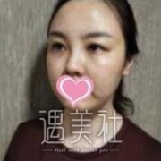四川省人民医院皮肤科光子嫩肤案例有吗？想看看~ width=