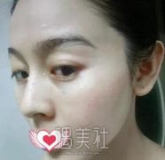 安医附院光子嫩肤怎么样？有案例分享看看吗？ width=