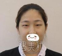 上海张东旭双眼皮案例：这楚楚动人的双眸有点心动~ width=