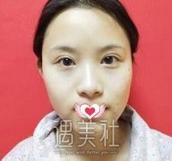 上海九院王涛隆鼻怎么样？真实案例分享~ width=