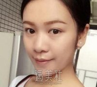 上海李建兵隆鼻案例：一周后就恢复得相当不错了！ width=