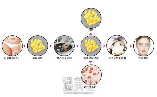 脂肪填充后多久定型，我想要了解一下~