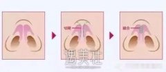 肉 毒杆菌能够缩小鼻翼吗?较近被这问题难住了~ width=