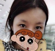 九院宋欣双眼皮案例：做个双眼皮给颜值锦上添花！ width=