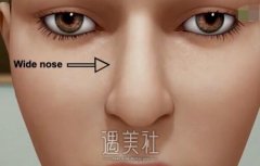 武汉驼峰鼻矫正术大约多少钱？是不是越贵越好？ width=