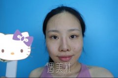辽宁协和整形外科医院价目表|假体隆鼻真的会改变颜值~ width=