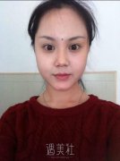 延吉金光善整形医院价目表|医院去颊脂垫前后对比案例~ width=