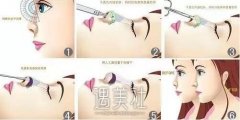 膨体隆鼻果好不好，看起来会不会很假? width=