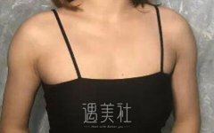 上海九院余力隆胸案例：假体隆胸变软过程日记来啦~ width=