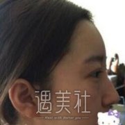 南京李俊隆鼻案例：朋友都说鼻子的弧度高度都刚刚好~ width=