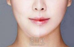 面部吸脂肿胀液怎么快速消肿？网上是这样的~ width=