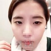桂林医学院附属医院割双眼皮案例：果不错~ width=