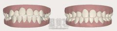 昆明牙齿矫正多少钱，那些人适合做? width=