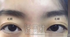钱文江全切双眼皮案例:亲身经历者来分享心得了 width=