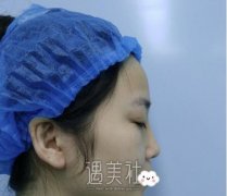 上海邱文苑隆鼻案例：告别多年塌鼻子！ width=