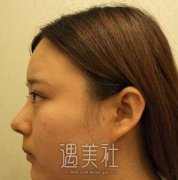 上海华山医院整形价目表|穆雄铮真实磨骨瘦脸案例分享~ width=