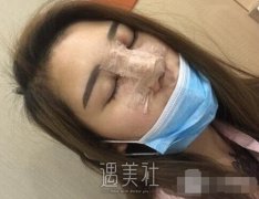 广州美莱整形医院价目表|罗延平152天韩式隆鼻分享~ width=