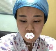 杭州时光吕敏隆鼻案例：隆鼻恢复过程图分享~ width=
