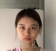 九院朱惠敏双眼皮案例：双眼皮随便画画都能美美哒~ width=