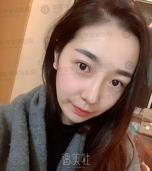 遇美社 整形日记 > 欧阳春鼻子案例:隆鼻找对医生很重要啊!