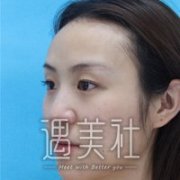天津坤如玛丽双眼皮怎么样?有案例给看下嘛? width=