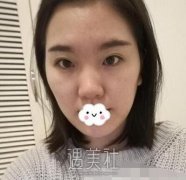 上海张余光双眼皮案例图片：线条优美弧度自然 width=