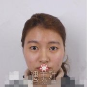 兰大二院孙一岚双眼皮案例：眼睛大了黑迷人！ width=
