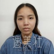 重庆西南医院整形科割双眼皮怎么样?真实案例展示~ width=