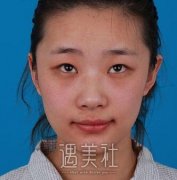 郑大二附院刘月丽双眼皮案例：大大眼睛老爸都羡慕 width=