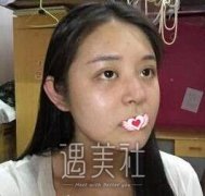 八大处王克明隆鼻案例：这鼻子才叫高挺俏丽呢~ width=