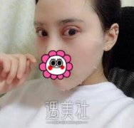 黄寺李敏双眼皮案例：这眼神气质堪比韩国小姐姐~ width=