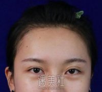 刘金超双眼皮修复案例：这次终于满意了！ width=