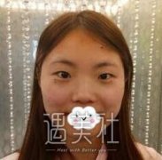 蔡仁祥双眼皮案例：蔡医生确实很擅长做双眼皮啊！ width=