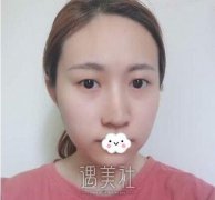 西京张辉双眼皮案例图：术后1-100天心路历程分享 width=