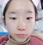 八大处杨明勇做双眼皮怎么样？有近期案例吗？ width=