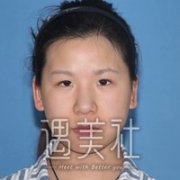 洛阳孔繁荣做双眼皮怎么样?有相关的案例展示吗? width=