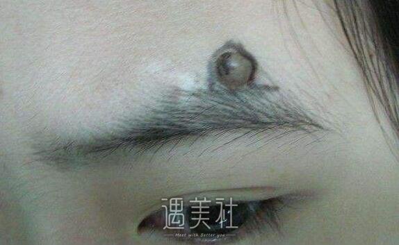 激光点痦子多久能洗脸?麻烦科普下~
