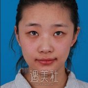 石家庄省二院张卓男双眼皮案例：术后真的很自然好看呢~ width=