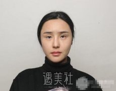 王珍祥修复双眼皮技术怎么样?有近期案例吗? width=