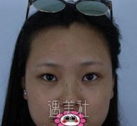 芜湖弋矶山潘勇双眼皮案例：形状和宽度是我想要的~ width=