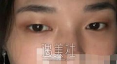 九院朱惠敏双眼皮案例：原来变美是如此轻松 width=