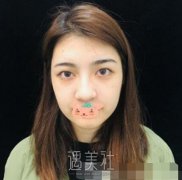 西安潘勇双眼皮果图：潘医生的技术精湛而细腻！ width=