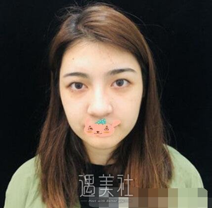西安,潘勇,双眼皮