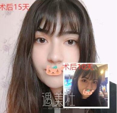 西安,潘勇,双眼皮